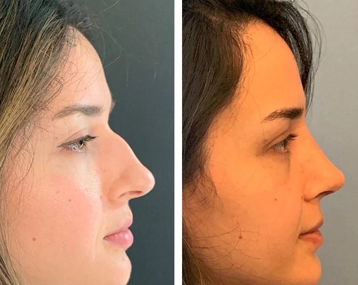 before & after photo of Rhinoplasty