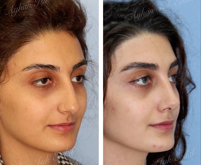 before & after photo of عملية تجميل الأنف