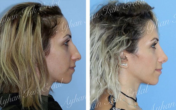 before & after photo of عملية تجميل الأنف