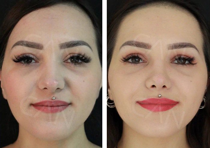 before & after photo of عملية تجميل الأنف