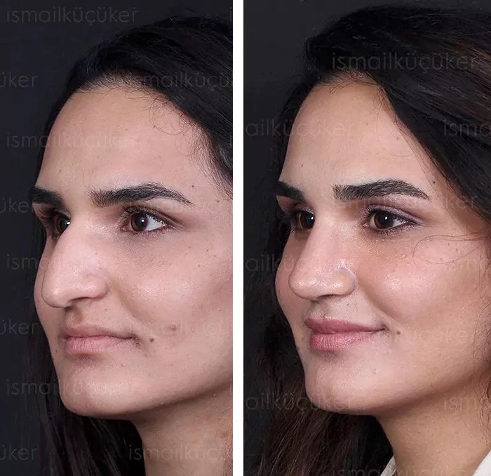 before & after photo of عملية الأنف الترميمية