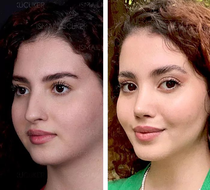 before & after photo of عملية الأنف الترميمية