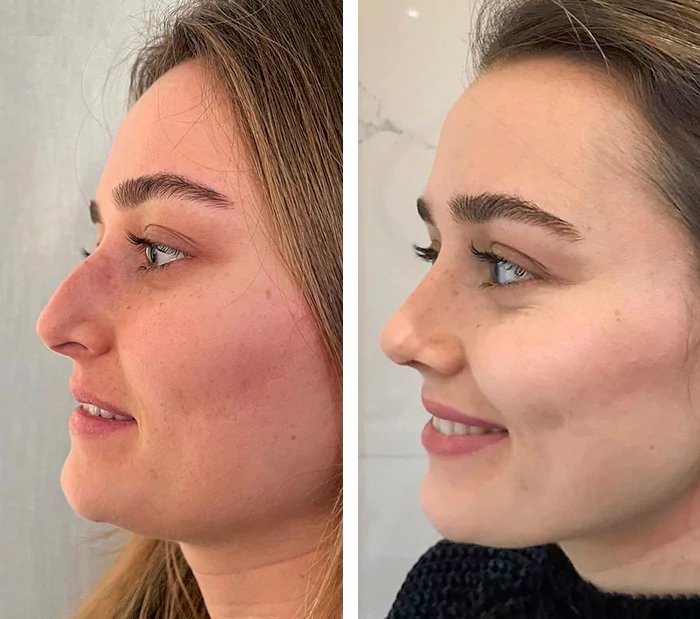 before & after photo of Rhinoplasty