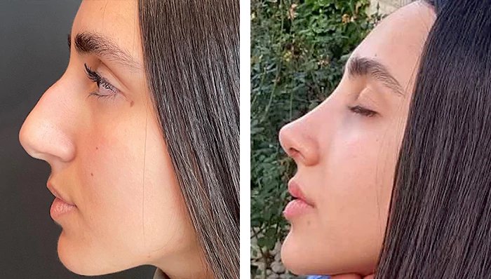 before & after photo of Rhinoplasty