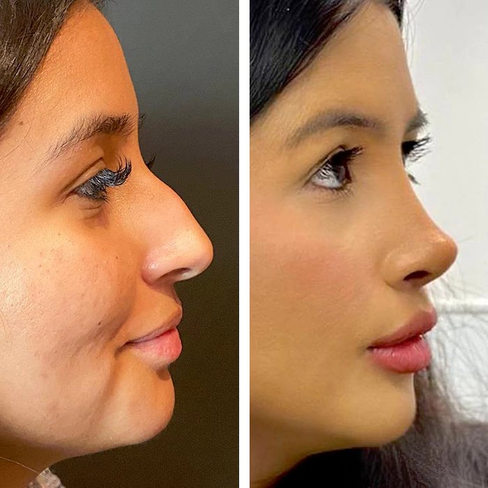 before & after photo of Rhinoplasty