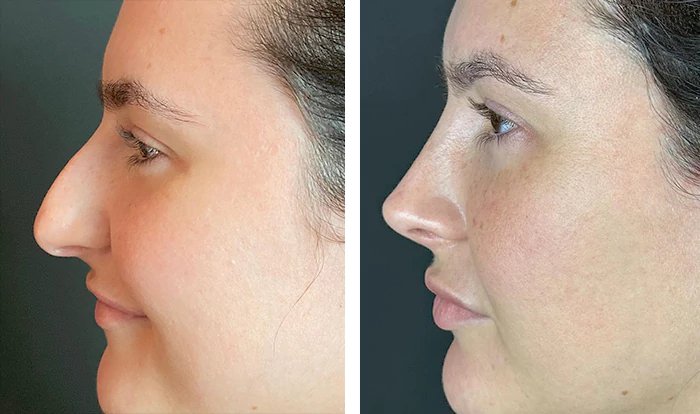 before & after photo of Rhinoplasty