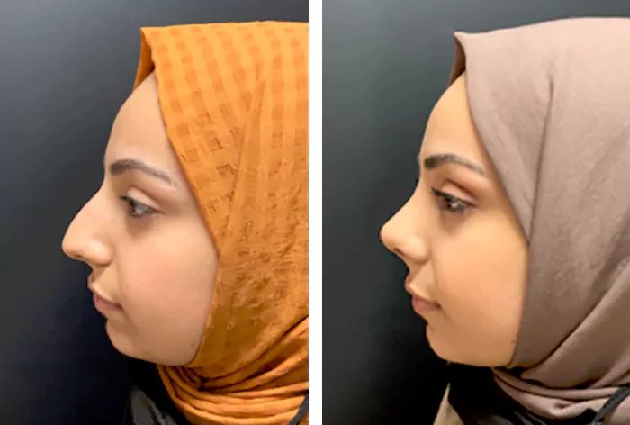 before & after photo of عملية تجميل الأنف