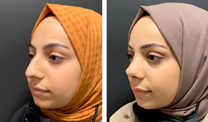 before & after photo of عملية تجميل الأنف