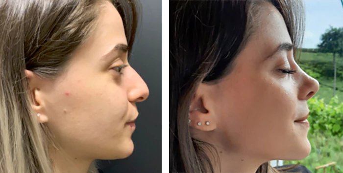 before & after photo of Rhinoplasty