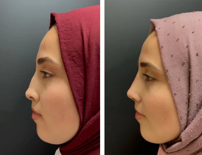 before & after photo of عملية تجميل الأنف