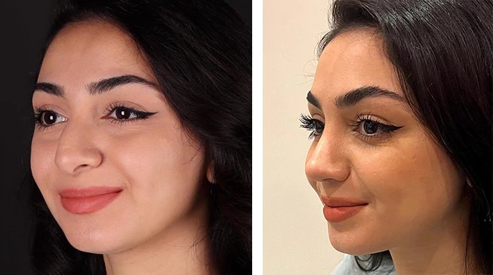 before & after photo of عملية تجميل الأنف