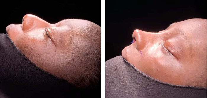 before & after photo of عملية تجميل الأنف