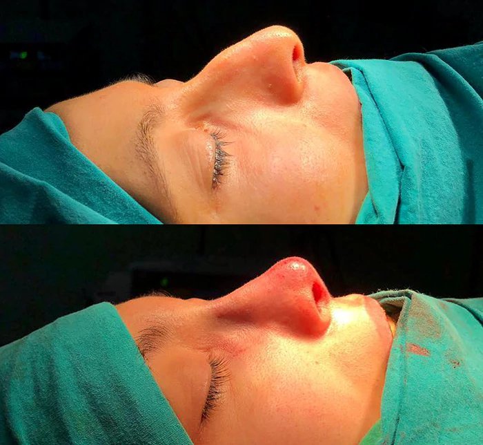 before & after photo of Rhinoplasty