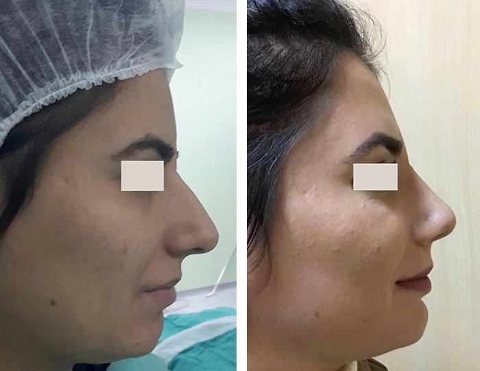 before & after photo of عملية تجميل الأنف