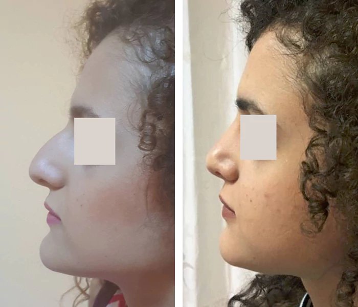 before & after photo of عملية تجميل الأنف