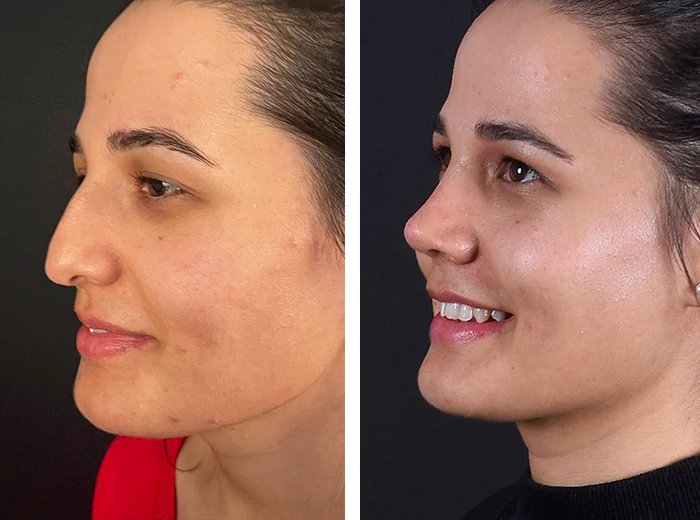 before & after photo of Rhinoplasty