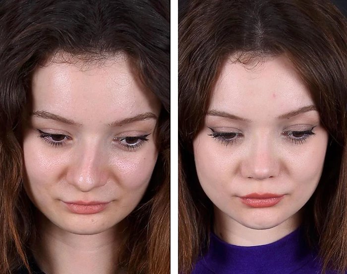 before & after photo of Rhinoplasty