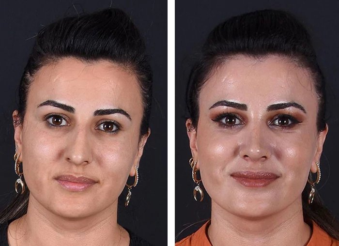 before & after photo of عملية تجميل الأنف