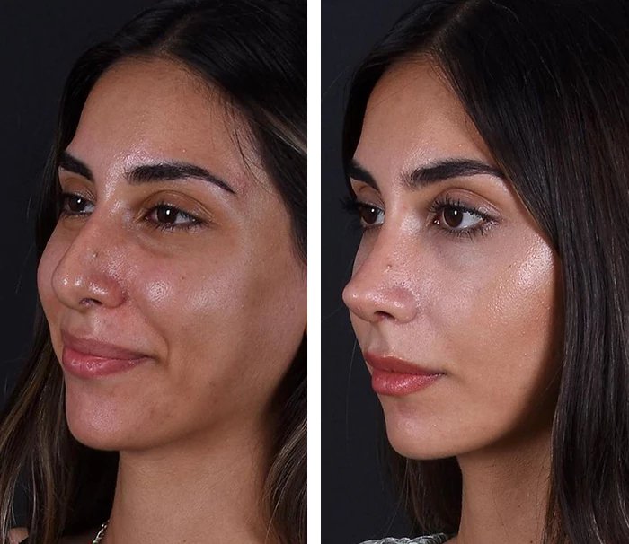 before & after photo of عملية تجميل الأنف