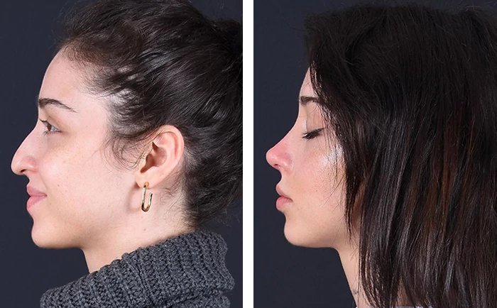 before & after photo of Rhinoplasty