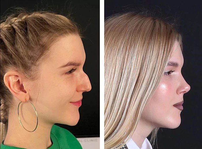 before & after photo of Rhinoplasty