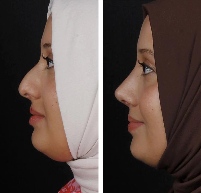 before & after photo of Revision Rhinoplasty