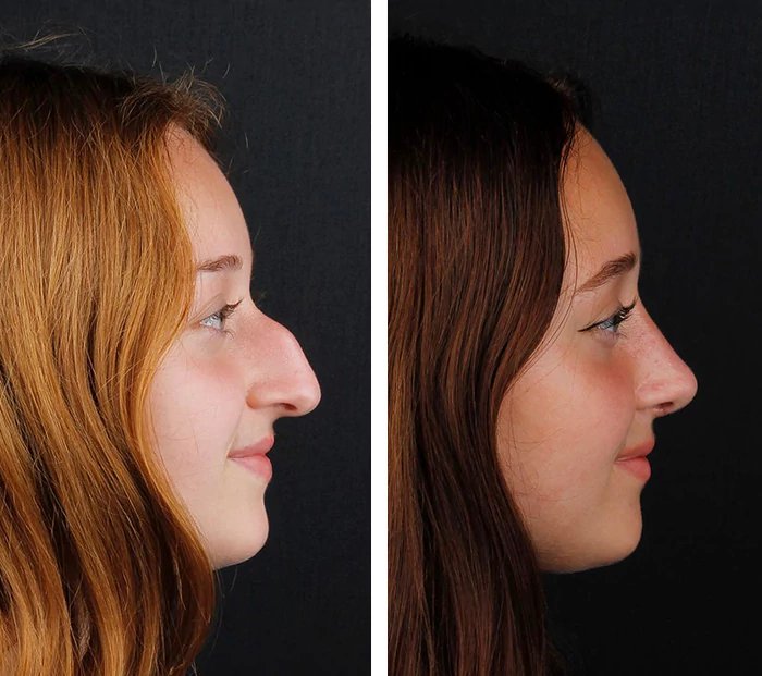 before & after photo of Revision Rhinoplasty