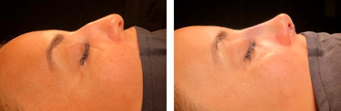 before & after photo of Revision Rhinoplasty