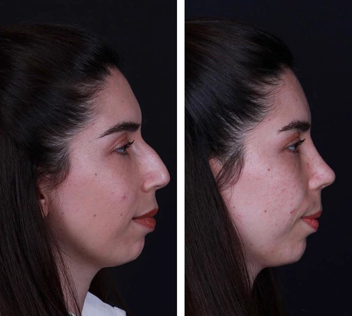 before & after photo of Rhinoplasty