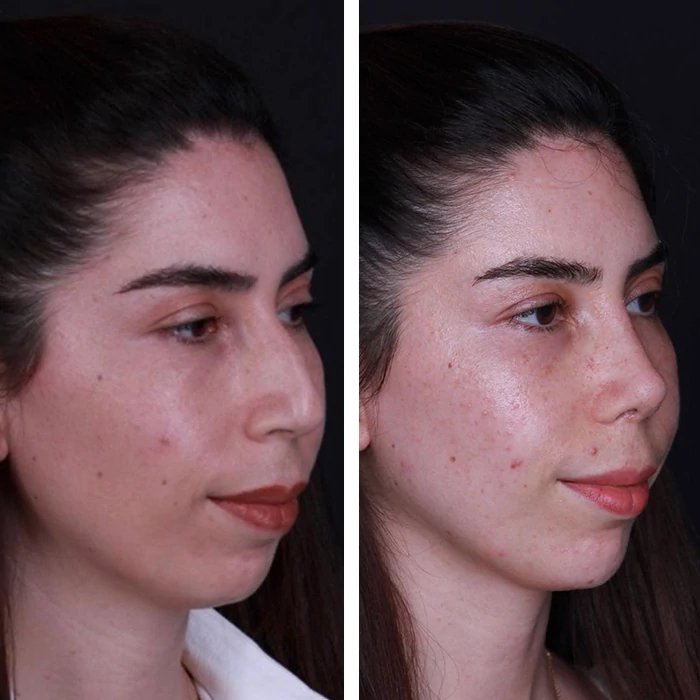 before & after photo of Rhinoplasty