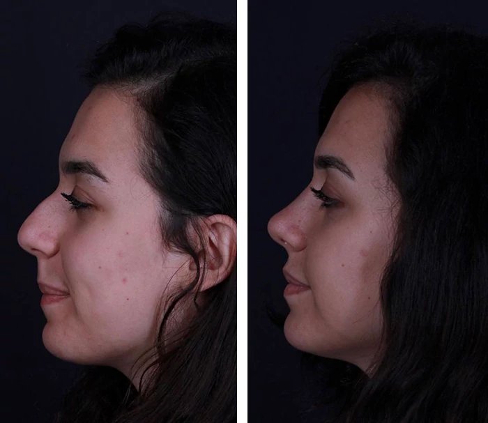 before & after photo of Rhinoplasty