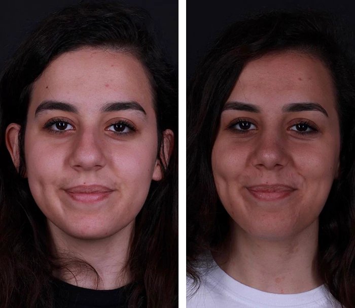 before & after photo of Rhinoplasty