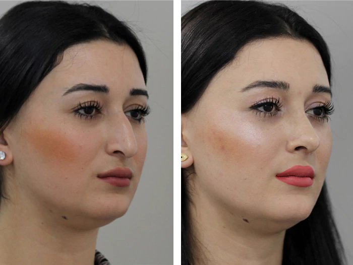 before & after photo of عملية تجميل الأنف