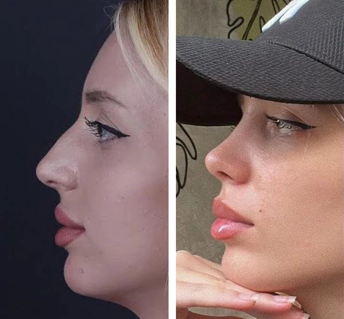 before & after photo of عملية تجميل الأنف