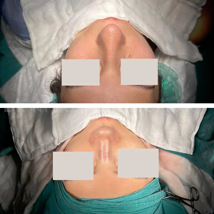 before & after photo of Rhinoplasty