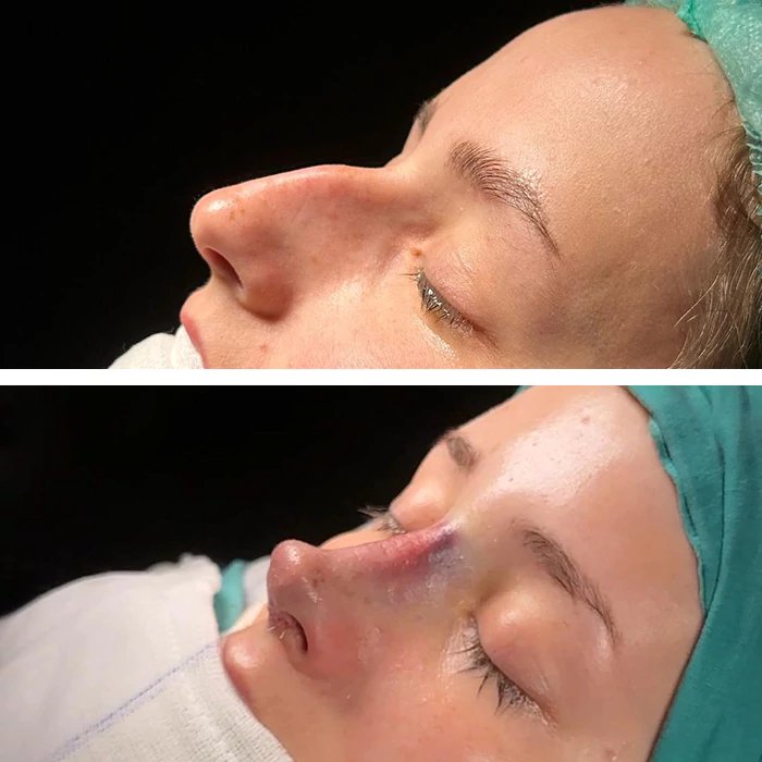 before & after photo of Rhinoplasty