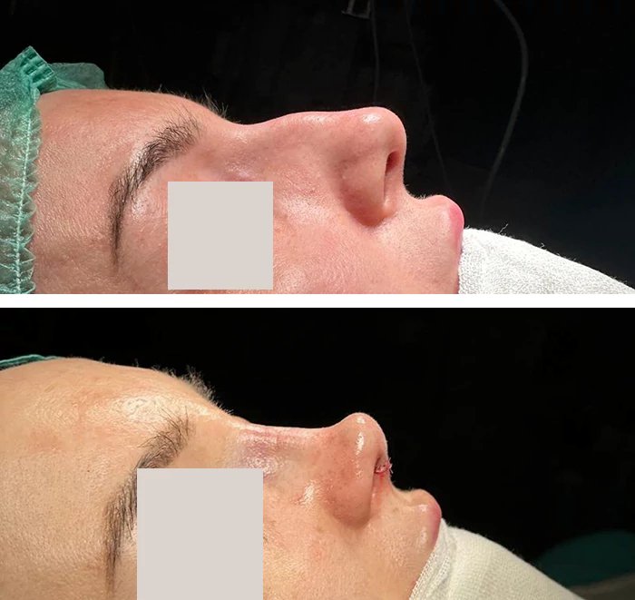 before & after photo of Rhinoplasty