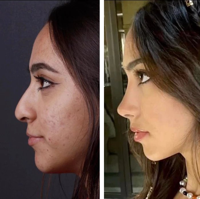 before & after photo of عملية تجميل الأنف