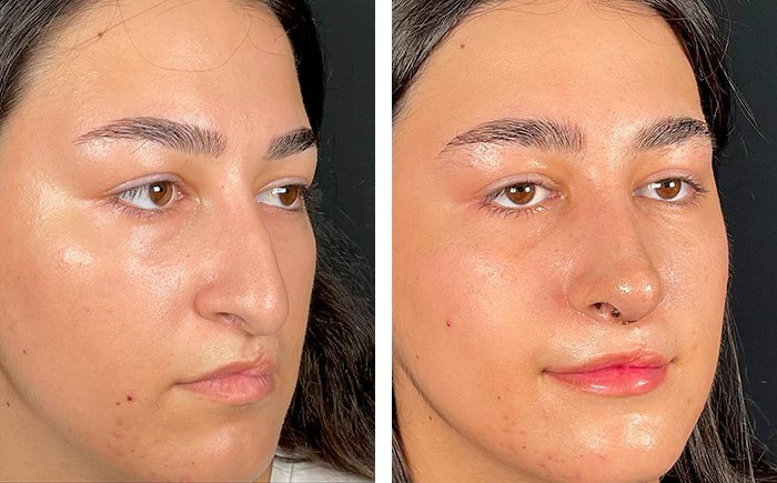 before & after photo of عملية تجميل الأنف