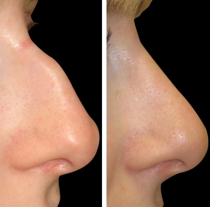 before & after photo of Rhinoplasty