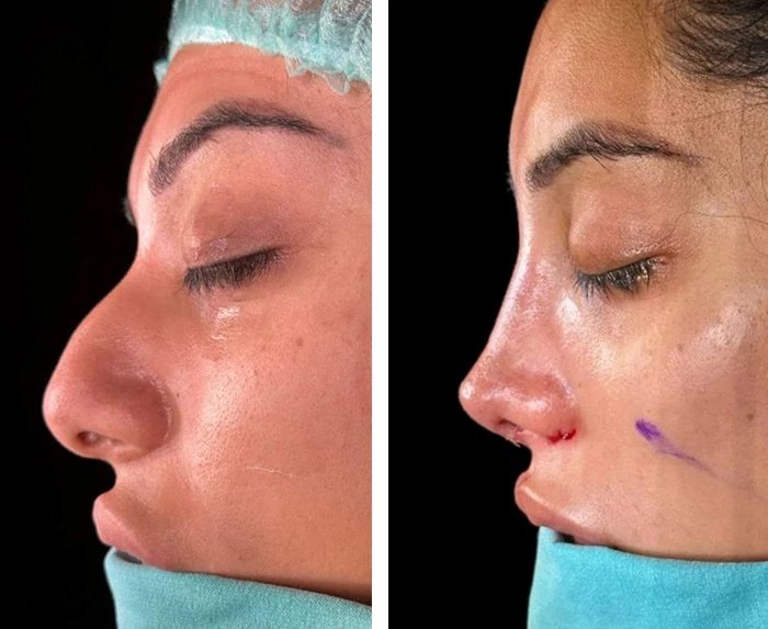 before & after photo of عملية تجميل الأنف