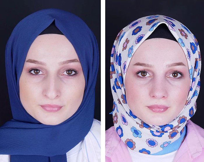 before & after photo of عملية تجميل الأنف