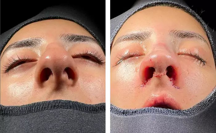 before & after photo of عملية تجميل الأنف