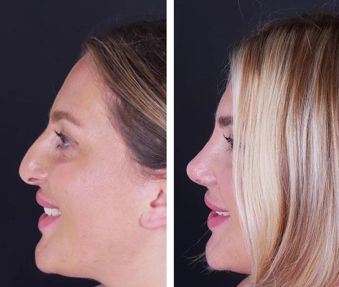 before & after photo of Rhinoplasty