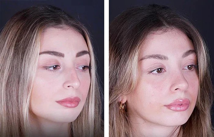 before & after photo of Rhinoplasty