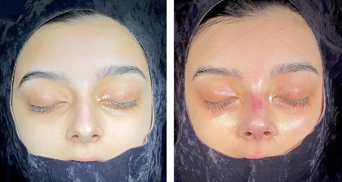 before & after photo of عملية تجميل الأنف