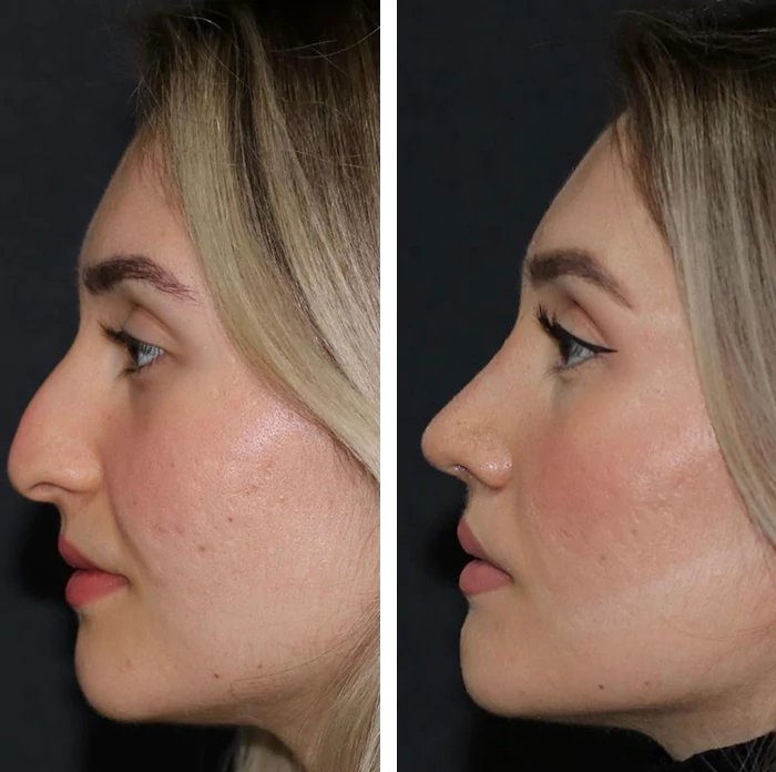 before & after photo of عملية تجميل الأنف