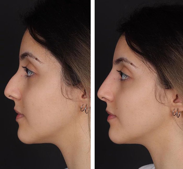 before & after photo of Rhinoplasty