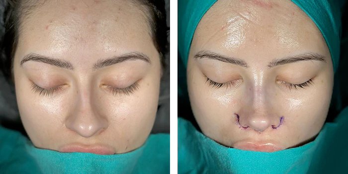 before & after photo of عملية تجميل الأنف