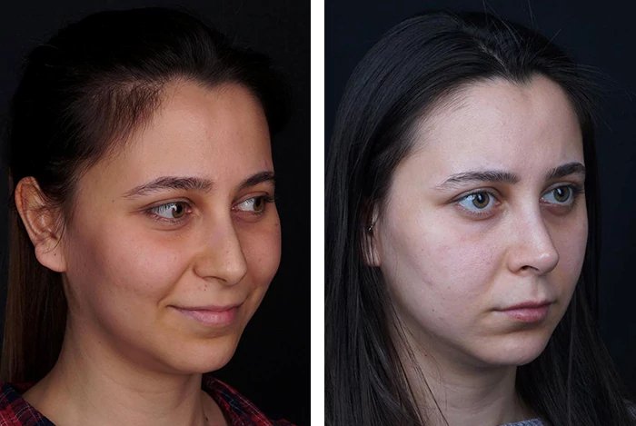 before & after photo of عملية تجميل الأنف